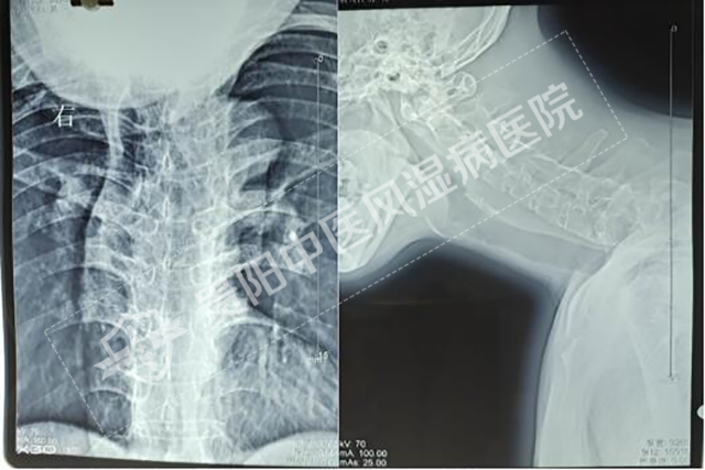 強(qiáng)直性脊柱炎患者影像2.jpg